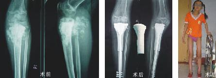 骨肉瘤能早期发现并治疗