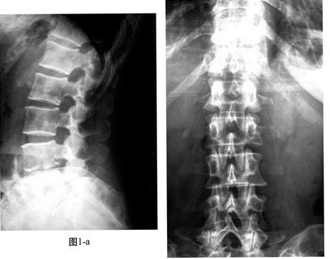脊柱肿瘤形成原因是什么