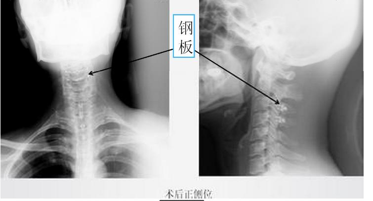脊柱肿瘤的症状有哪些呢