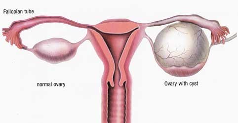 诱发卵巢癌的各种因素