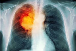 肺癌的治疗误区