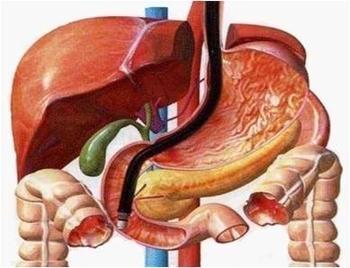 胰腺癌的早期警号