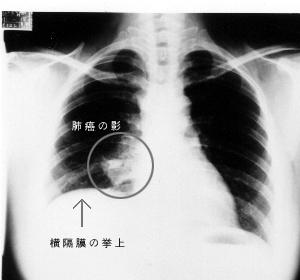 肺癌预防有五招