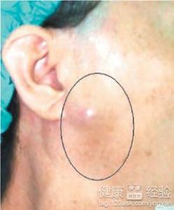 肿瘤手术后怎么生活才容易康复？