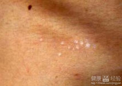 鳞状上皮细胞癌去医院需要做什么检查呢？