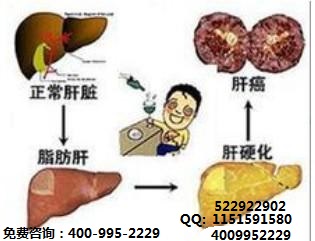 如何发现早期肝癌
