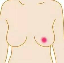 石家庄肿瘤医院教你预防乳腺癌